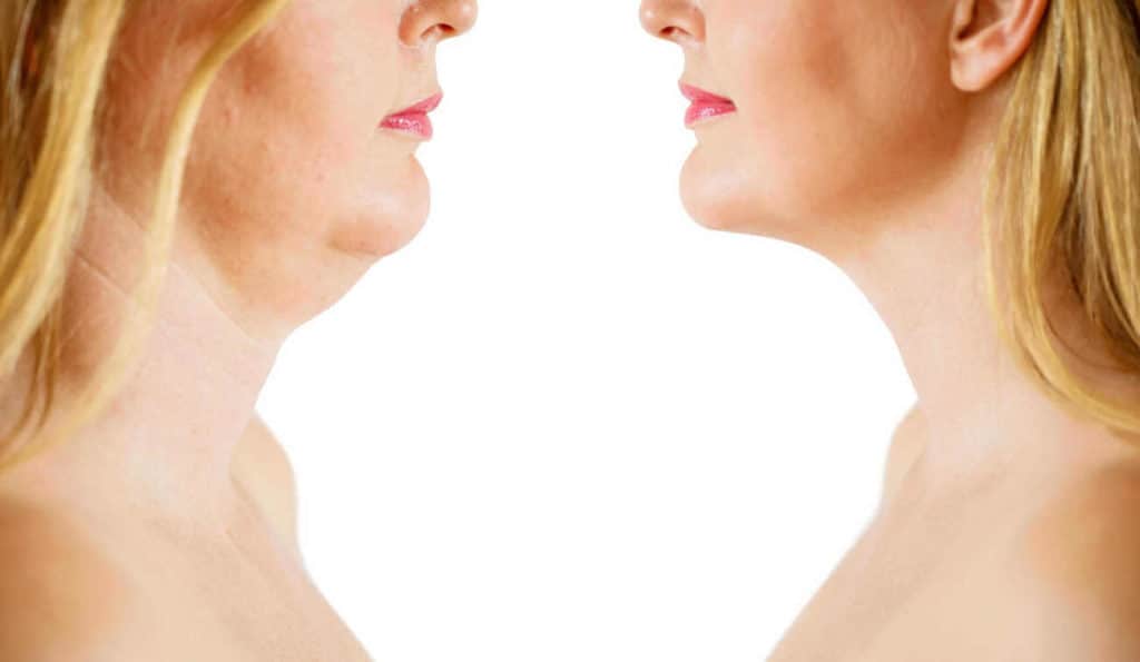 Double Chin treatment Southgate before and after results