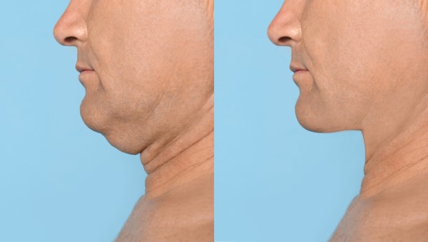 Which Non-Surgical Treatments Work Best for Jowls and Loose Skin Southgate?