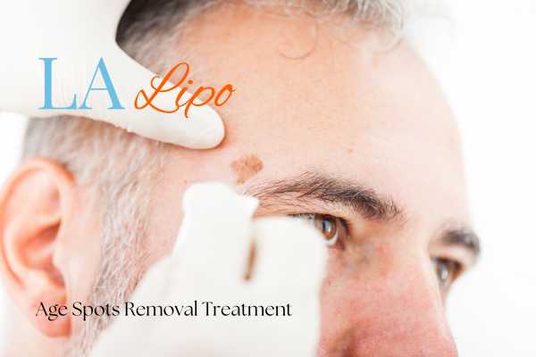 What Are the Most Effective Treatments for Age Spots Southgate?