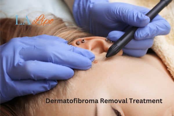 Dermatofibroma Removal Treatment Southgate