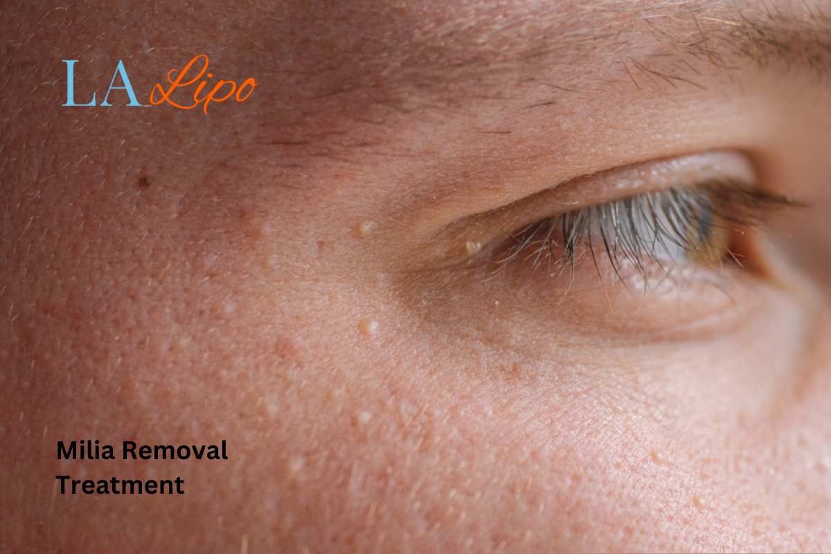 Cryopen Milia Removal: Is It the Easiest and Safest Option Southgate?