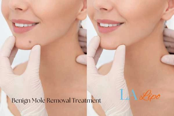 woman's before and after mole removal Southgate results