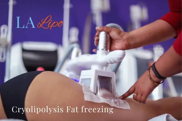 women getting fat freezing Southgate