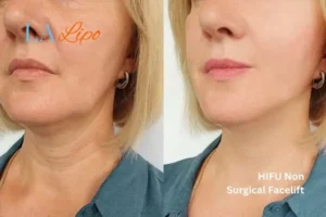 hi-fu for wrinkles Southgate before and after results