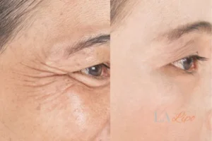 Before and after results of woman - HI-fu wrinkles reduction treatment Southgate