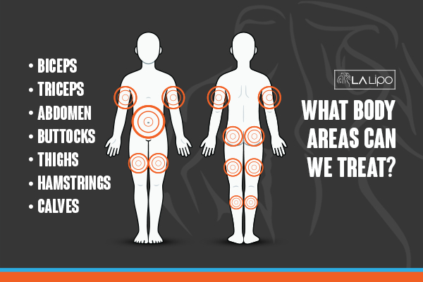 Graphic to show areas you can have LA-EMS Body Sculpting Southgate treatment.
