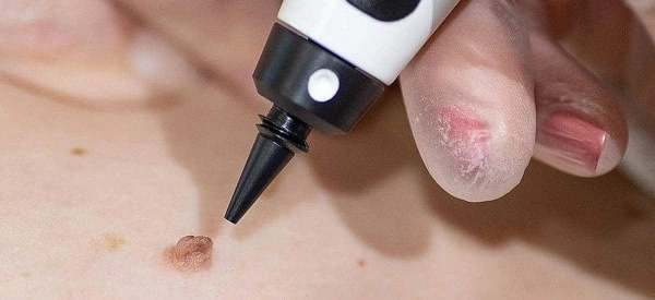 skin tag removal using cryopen Southgate