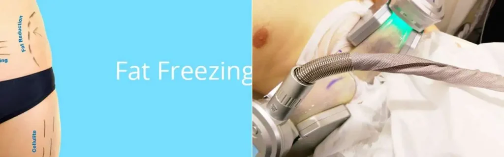 Fat freezing Southgate on multiple areas of the body