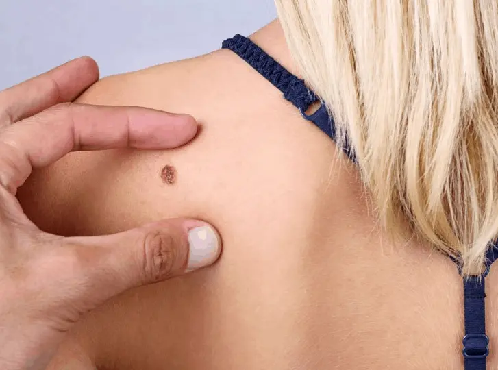 woman having mole removal Southgate consultation before treatment.