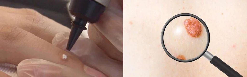 CryoPen practitioner Southgate assessing a benign mole before treatment