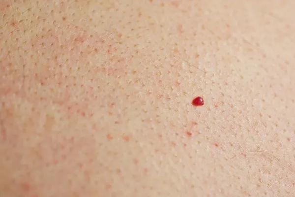 close up of a cherry angioma Southgate