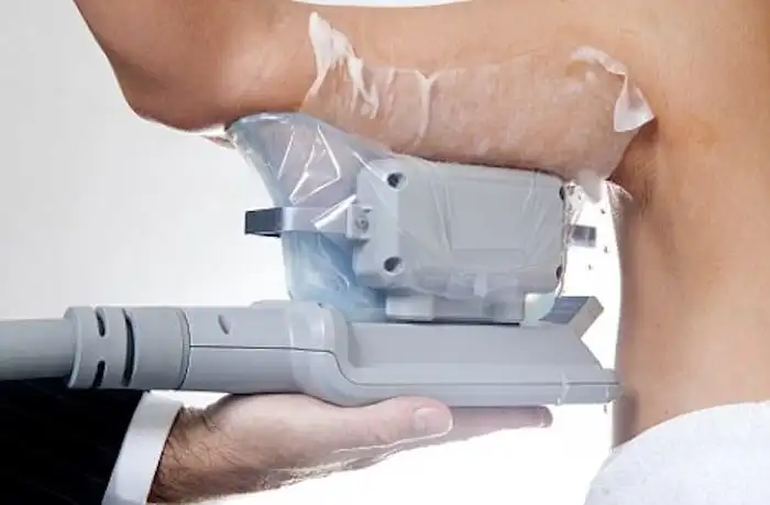 Picture of fat freezing Southgate on the upper arms.