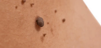 image of a skin tag Southgate