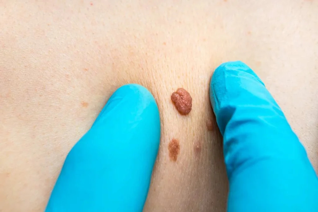 Consultant examining a skin tag Southgate