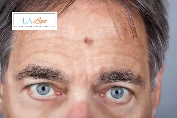 Solar Lentigo Removal Southgate image of man with mark on his forehead