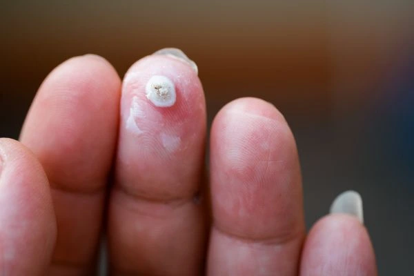 wart on person finger - cryotherapy to treat from LA LIPO Southgate