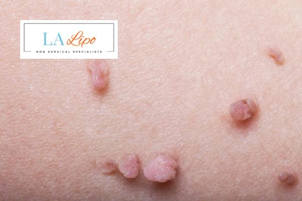 Does cryopen skin tag removal Southgate hurt? Find out now call our team today!