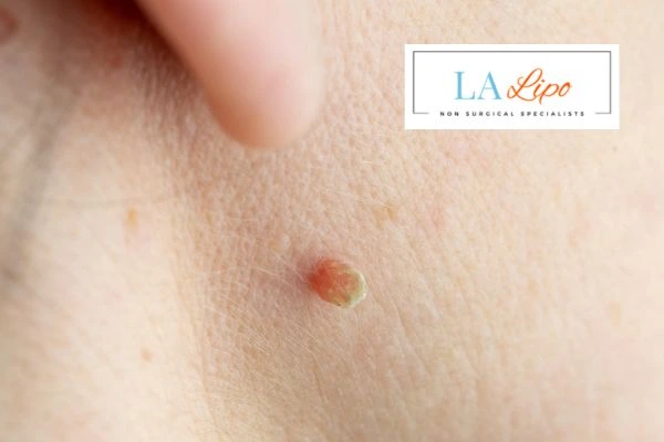 Book skin tag removal Southgate today speak to our team now!