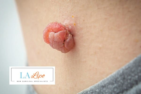 Interested in skin tag removal Southgate? Concerned about the pain? Find out more today!