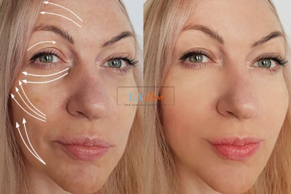 Morpheus 8 results Southgate face lift.