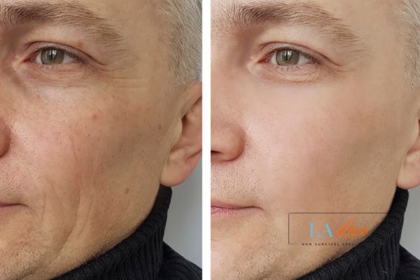 See the amazing results of Morpheus8 Treatment Southgate!