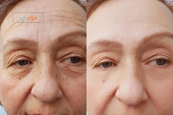 The powerful benefits of Morpheus8 Treatment Southgate - Call Our team today!
