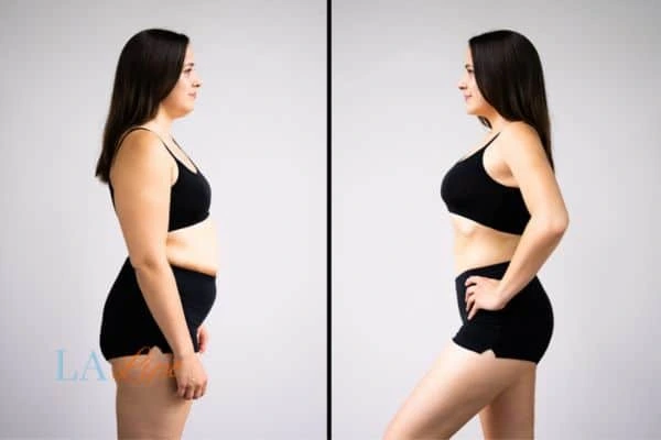Picture of womans before and after using LA-EMS body sculpting to improve her core strength Southgate