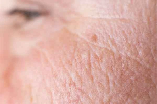 close up picture of a woman's face showing an age spot Southgate