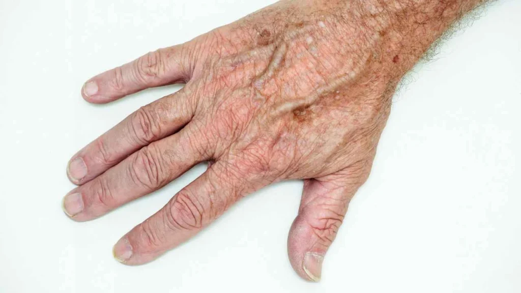 Male hand showing age spot Southgate