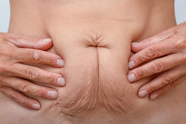 Image of a woman's stomach with loose skin - example of skin tightening Southgate options