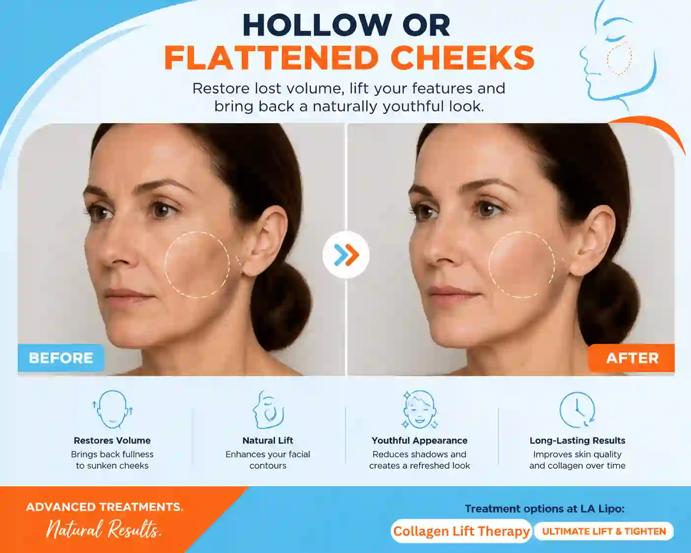 Sign #4: Hollow or Flattened Cheeks Southgate