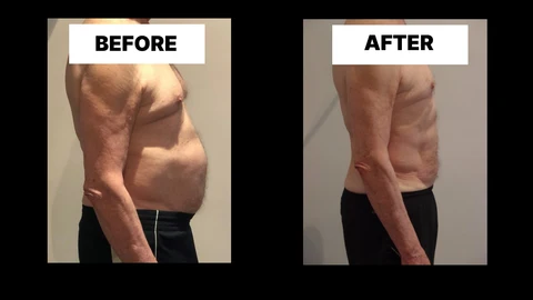 What Symptoms Can Diastasis Recti Cause in Men? Weak Core, Back Pain and Poor Posture Southgate
